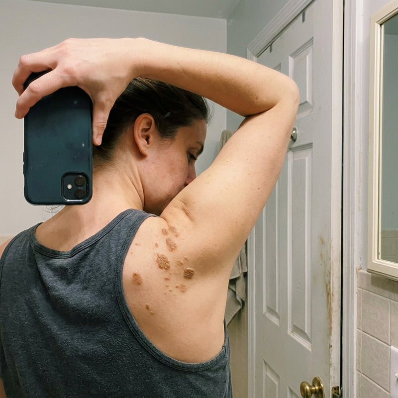 Seborrheic Keratoses