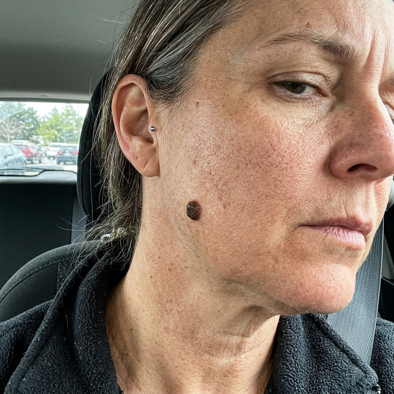 Warts & Dark Moles
